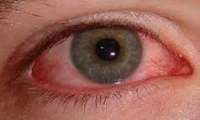 قرمزی چشم بعد از شنا در استخر، سبب آسیب درازمدت نمی شود.