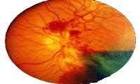 دیابت علت اصلی نابینایی در سنین 30 تا 70 سالگی است